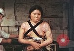 Image of burn wounds from atomic bomb Hiroshima Japan, 1946, second 37 stock footage video 65675060683