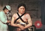 Image of burn wounds from atomic bomb Hiroshima Japan, 1946, second 38 stock footage video 65675060683