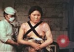 Image of burn wounds from atomic bomb Hiroshima Japan, 1946, second 39 stock footage video 65675060683