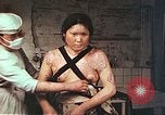 Image of burn wounds from atomic bomb Hiroshima Japan, 1946, second 40 stock footage video 65675060683
