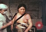 Image of burn wounds from atomic bomb Hiroshima Japan, 1946, second 41 stock footage video 65675060683