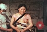 Image of burn wounds from atomic bomb Hiroshima Japan, 1946, second 42 stock footage video 65675060683