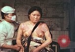 Image of burn wounds from atomic bomb Hiroshima Japan, 1946, second 43 stock footage video 65675060683