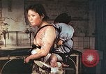 Image of burn wounds from atomic bomb Hiroshima Japan, 1946, second 54 stock footage video 65675060683