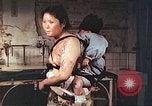 Image of burn wounds from atomic bomb Hiroshima Japan, 1946, second 56 stock footage video 65675060683