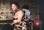 Image of burn wounds from atomic bomb Hiroshima Japan, 1946, second 57 stock footage video 65675060683