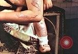 Image of burn wounds from atomic bomb Hiroshima Japan, 1946, second 58 stock footage video 65675060683