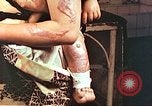 Image of burn wounds from atomic bomb Hiroshima Japan, 1946, second 59 stock footage video 65675060683