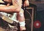 Image of burn wounds from atomic bomb Hiroshima Japan, 1946, second 60 stock footage video 65675060683