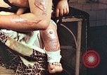 Image of burn wounds from atomic bomb Hiroshima Japan, 1946, second 61 stock footage video 65675060683
