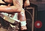 Image of burn wounds from atomic bomb Hiroshima Japan, 1946, second 62 stock footage video 65675060683