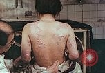 Standbild Burns auf der Rückseite der Atombombe Opfer Hiroshima Japan, 1946, aus Sekunde 3 historischem Filmmaterial Videoclip 65675060687