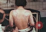 Standbild Burns auf der Rückseite der Atombombe Opfer Hiroshima Japan, 1946, aus Sekunde 4 historischem Filmmaterial Videoclip 65675060687