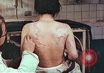 Standbild Burns auf der Rückseite der Atombombe Opfer Hiroshima Japan, 1946, aus Sekunde 5 historischem Filmmaterial Videoclip 65675060687