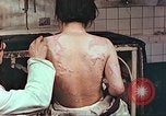 Standbild Burns auf der Rückseite der Atombombe Opfer Hiroshima Japan, 1946, aus Sekunde 6 historischem Filmmaterial Videoclip 65675060687