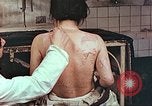 Standbild Burns auf der Rückseite der Atombombe Opfer Hiroshima Japan, 1946, aus Sekunde 7 historischem Filmmaterial Videoclip 65675060687