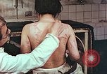 Standbild Burns auf der Rückseite der Atombombe Opfer Hiroshima Japan, 1946, aus Sekunde 8 historischem Filmmaterial Videoclip 65675060687