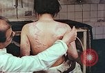 Standbild Burns auf der Rückseite der Atombombe Opfer Hiroshima Japan, 1946, aus Sekunde 9 historischem Filmmaterial Videoclip 65675060687