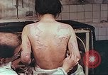 Standbild Burns auf der Rückseite der Atombombe Opfer Hiroshima Japan, 1946, aus Sekunde 12 historischem Filmmaterial Videoclip 65675060687