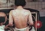 Standbild Burns auf der Rückseite der Atombombe Opfer Hiroshima Japan, 1946, aus Sekunde 13 historischem Filmmaterial Videoclip 65675060687