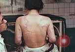Standbild Burns auf der Rückseite der Atombombe Opfer Hiroshima Japan, 1946, aus Sekunde 14 historischem Filmmaterial Videoclip 65675060687