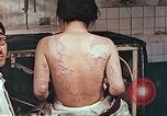 Standbild Burns auf der Rückseite der Atombombe Opfer Hiroshima Japan, 1946, aus Sekunde 16 historischem Filmmaterial Videoclip 65675060687