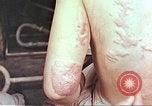 Standbild Burns auf der Rückseite der Atombombe Opfer Hiroshima Japan, 1946, aus Sekunde 18 historischem Filmmaterial Videoclip 65675060687