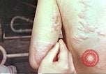 Standbild Burns auf der Rückseite der Atombombe Opfer Hiroshima Japan, 1946, aus Sekunde 19 historischem Filmmaterial Videoclip 65675060687