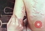 Standbild Burns auf der Rückseite der Atombombe Opfer Hiroshima Japan, 1946, aus Sekunde 20 historischem Filmmaterial Videoclip 65675060687
