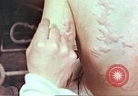Standbild Burns auf der Rückseite der Atombombe Opfer Hiroshima Japan, 1946, aus Sekunde 21 historischem Filmmaterial Videoclip 65675060687