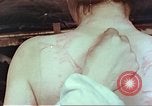 Standbild Burns auf der Rückseite der Atombombe Opfer Hiroshima Japan, 1946, aus Sekunde 25 historischem Filmmaterial Videoclip 65675060687