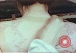 Standbild Burns auf der Rückseite der Atombombe Opfer Hiroshima Japan, 1946, aus Sekunde 26 historischem Filmmaterial Videoclip 65675060687