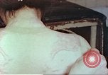 Standbild Burns auf der Rückseite der Atombombe Opfer Hiroshima Japan, 1946, aus Sekunde 28 historischem Filmmaterial Videoclip 65675060687