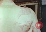 Standbild Burns auf der Rückseite der Atombombe Opfer Hiroshima Japan, 1946, aus Sekunde 30 historischem Filmmaterial Videoclip 65675060687