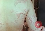 Standbild Burns auf der Rückseite der Atombombe Opfer Hiroshima Japan, 1946, aus Sekunde 31 historischem Filmmaterial Videoclip 65675060687