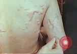 Standbild Burns auf der Rückseite der Atombombe Opfer Hiroshima Japan, 1946, aus Sekunde 32 historischem Filmmaterial Videoclip 65675060687