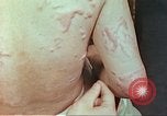 Standbild Burns auf der Rückseite der Atombombe Opfer Hiroshima Japan, 1946, aus Sekunde 33 historischem Filmmaterial Videoclip 65675060687