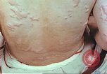 Standbild Burns auf der Rückseite der Atombombe Opfer Hiroshima Japan, 1946, aus Sekunde 35 historischem Filmmaterial Videoclip 65675060687