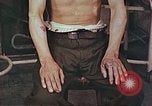 Image of burns on atomic bomb victims Hiroshima Japan, 1946, second 3 stock footage video 65675060688