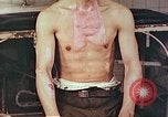 Image of burns on atomic bomb victims Hiroshima Japan, 1946, second 8 stock footage video 65675060688