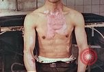 Image of burns on atomic bomb victims Hiroshima Japan, 1946, second 9 stock footage video 65675060688