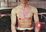 Image of burns on atomic bomb victims Hiroshima Japan, 1946, second 10 stock footage video 65675060688