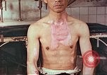 Image of burns on atomic bomb victims Hiroshima Japan, 1946, second 11 stock footage video 65675060688
