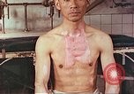Image of burns on atomic bomb victims Hiroshima Japan, 1946, second 12 stock footage video 65675060688