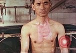 Image of burns on atomic bomb victims Hiroshima Japan, 1946, second 13 stock footage video 65675060688