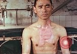 Image of burns on atomic bomb victims Hiroshima Japan, 1946, second 14 stock footage video 65675060688