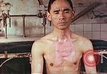 Image of burns on atomic bomb victims Hiroshima Japan, 1946, second 15 stock footage video 65675060688