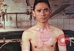 Image of burns on atomic bomb victims Hiroshima Japan, 1946, second 16 stock footage video 65675060688