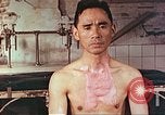 Image of burns on atomic bomb victims Hiroshima Japan, 1946, second 17 stock footage video 65675060688