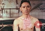 Image of burns on atomic bomb victims Hiroshima Japan, 1946, second 18 stock footage video 65675060688